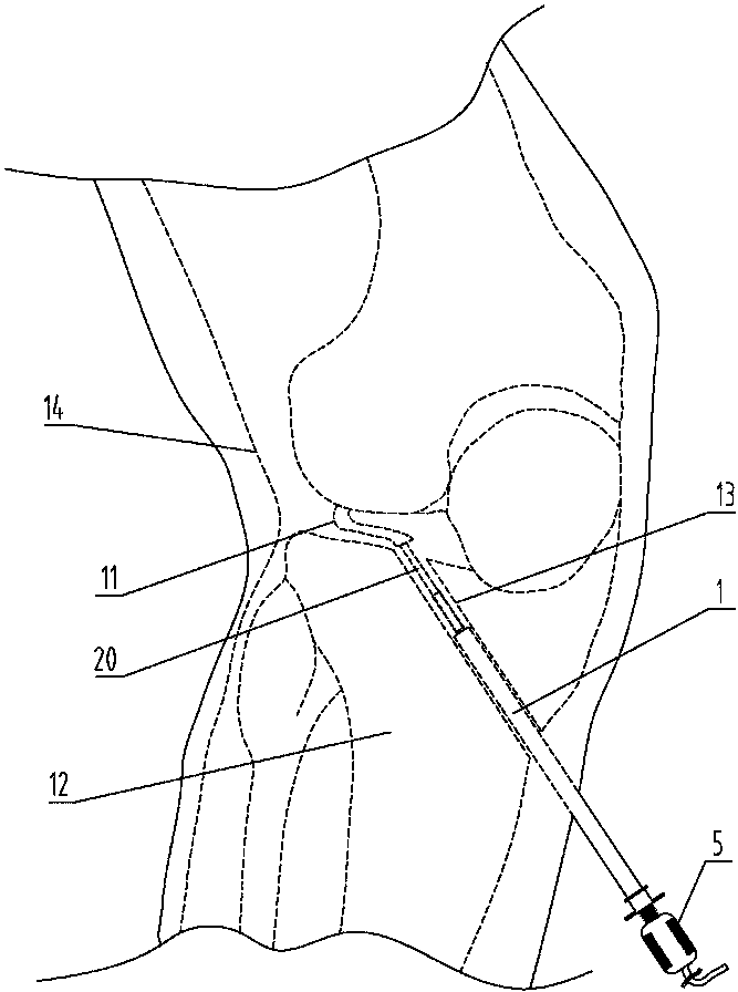 cn108125715a_后交叉韧带胫骨止点隧道导向器在审