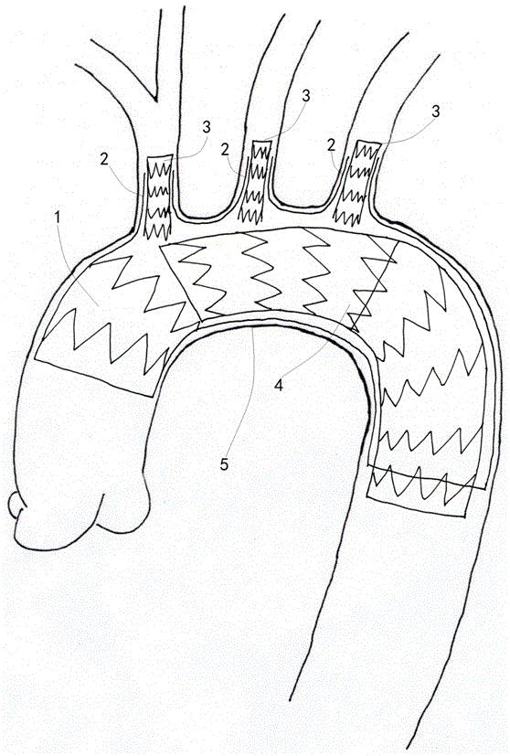 一种新型主动脉弓部带分支覆膜支架型血管组合件