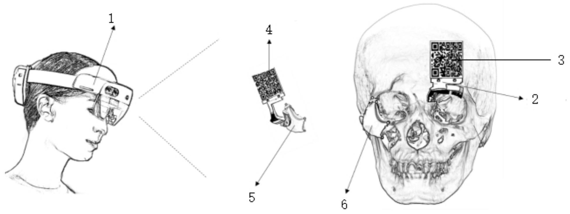一种基于增强现实的颅颌面骨折修复导航系统