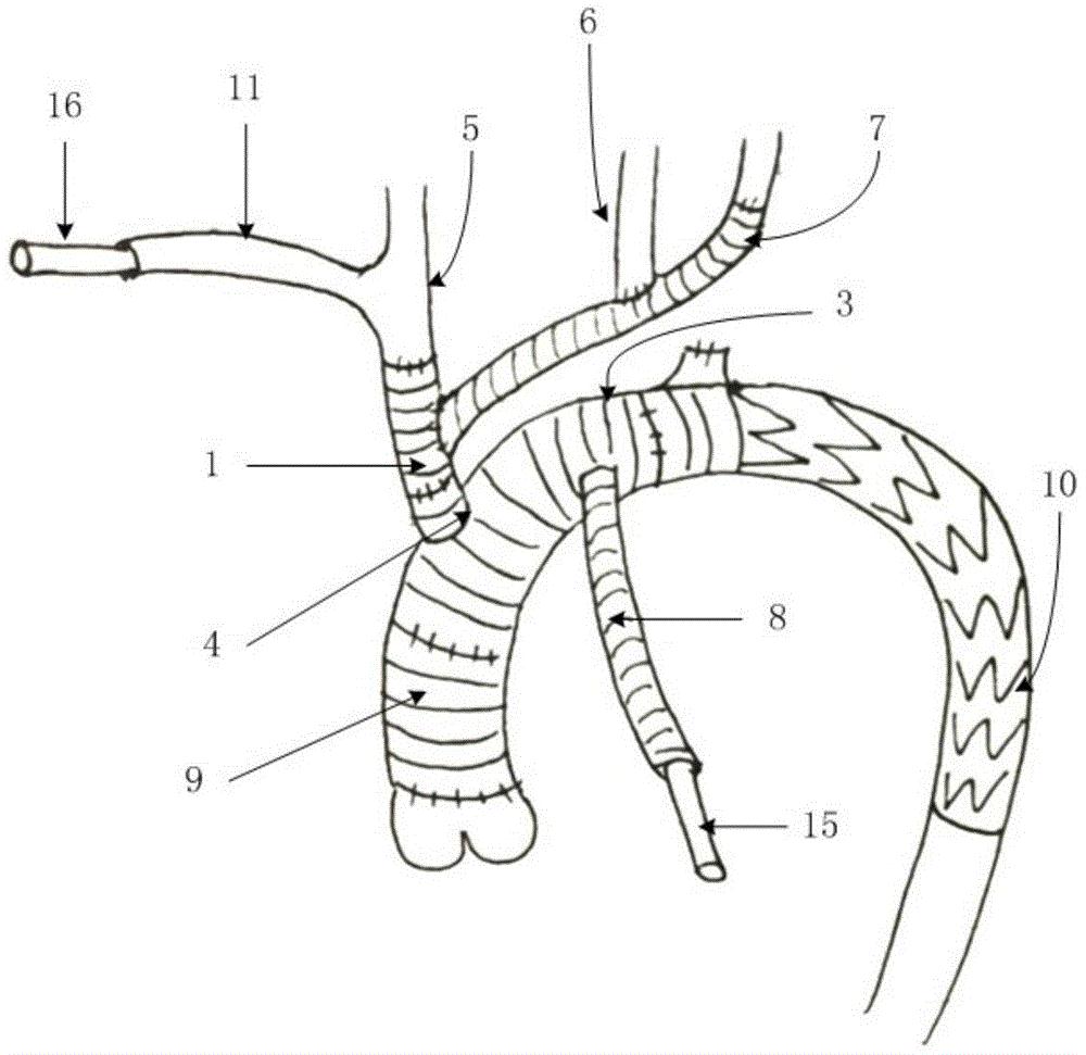一种应用于主动脉弓置换的人工血管