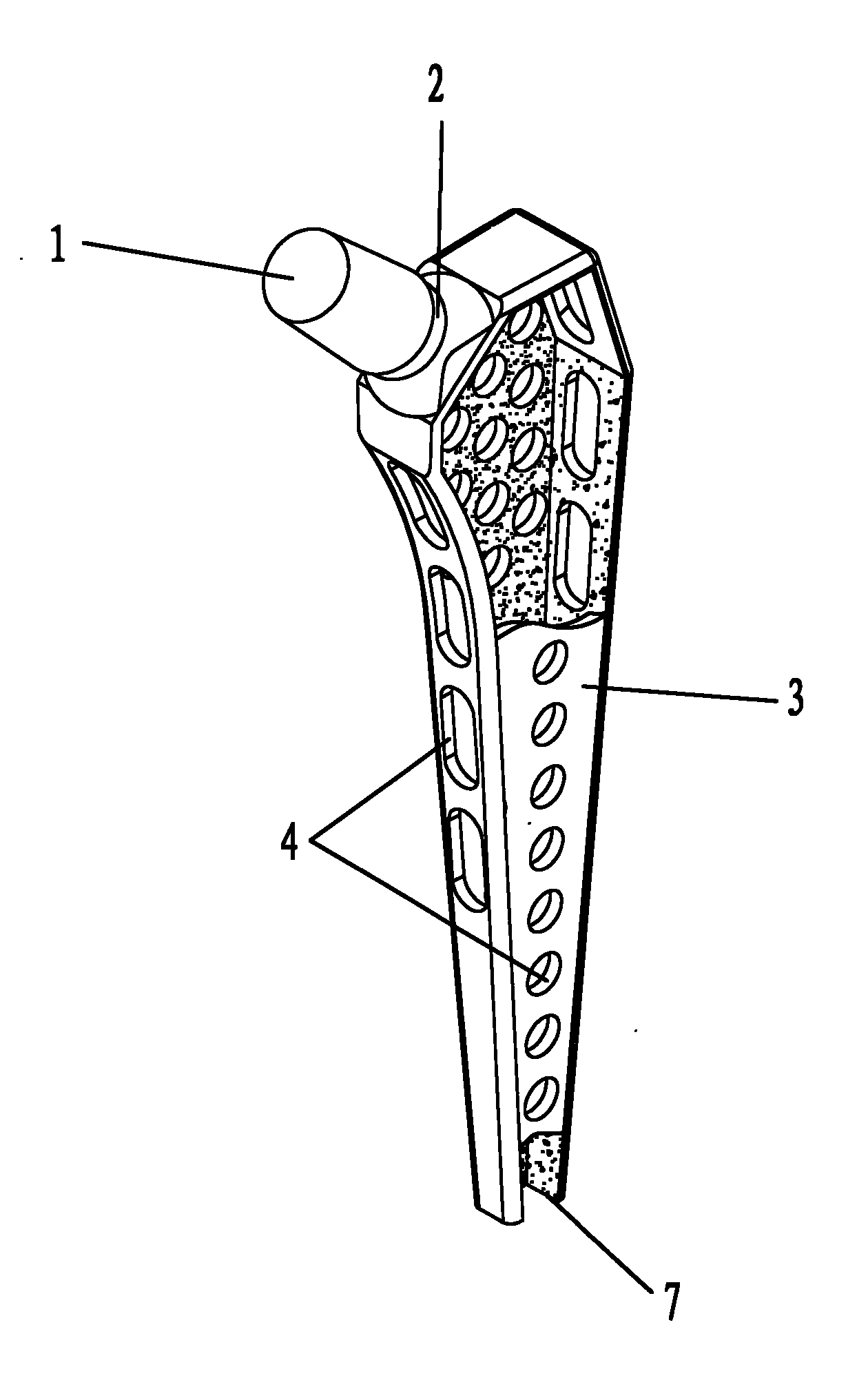 低弹性模量人工髋关节股骨柄