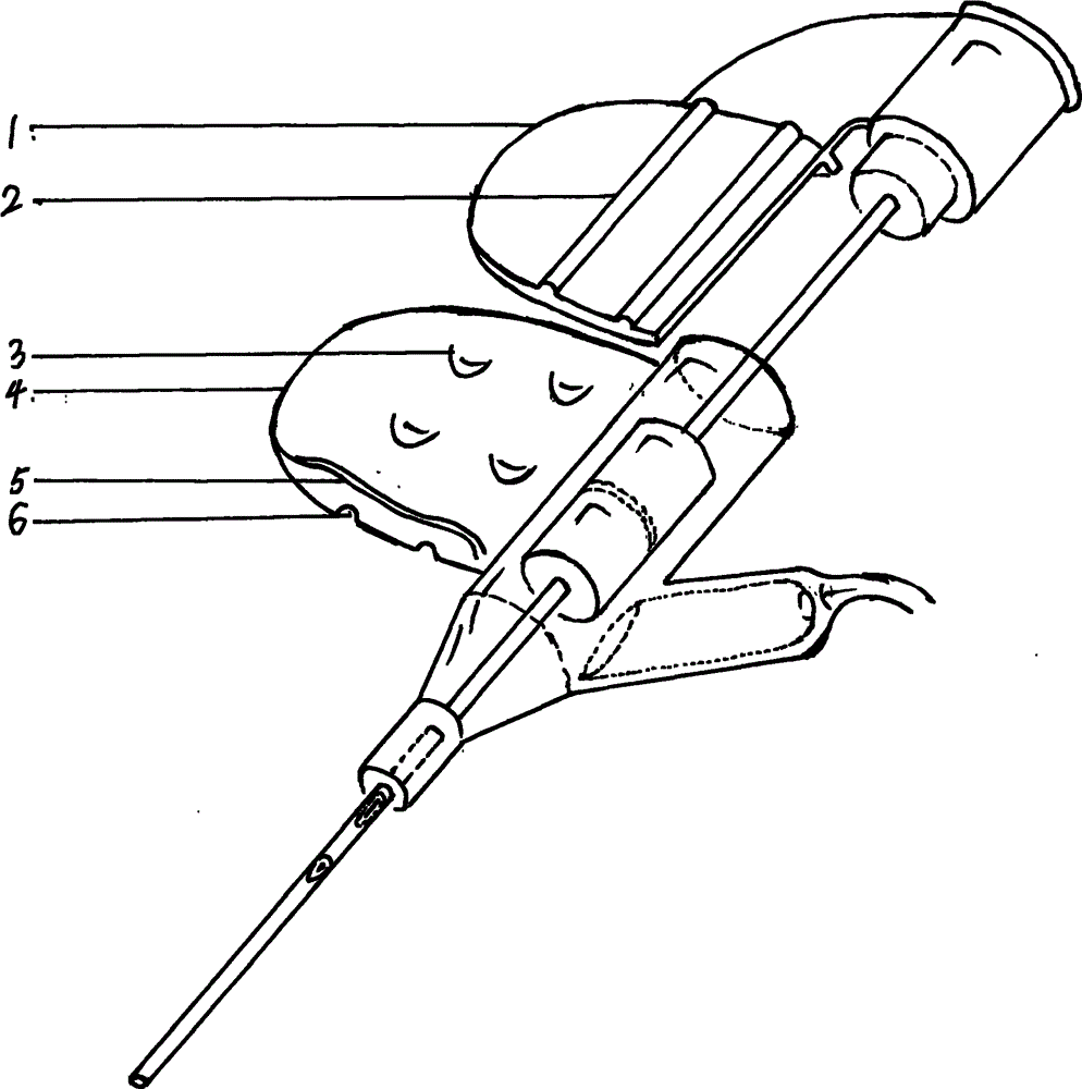 一次性单手送管式静脉留置针头(如说明书摘要附图)是一种可以简化护理