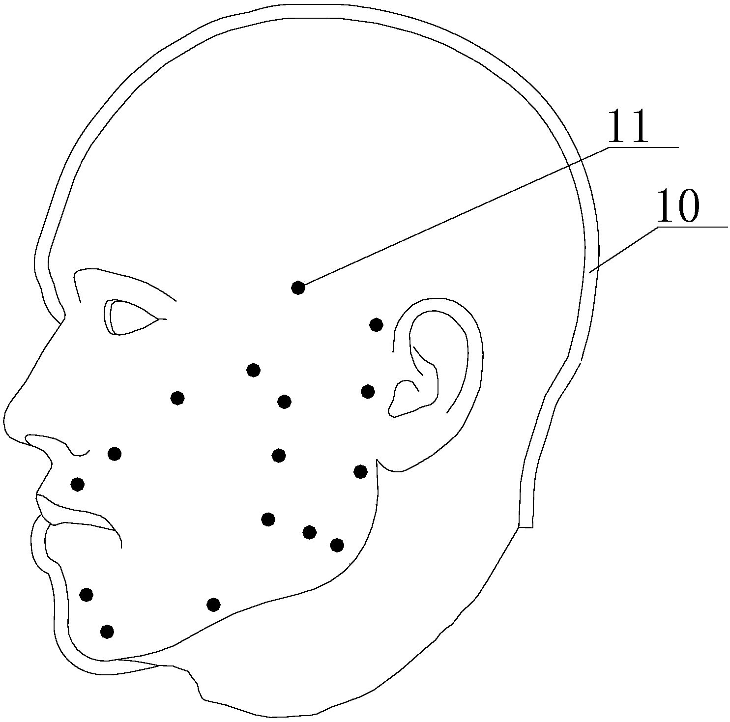 cn106963639a_颊部治疗装置,颊针治疗装置和针灸装置有效
