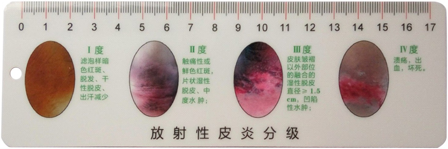 cn303838754s_测量尺(放射性皮炎)失效