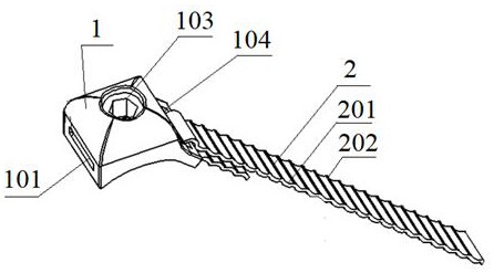所述捆绑带,由于环扎带的波纹状结构,其与骨骼的接触面积宽,压力分布