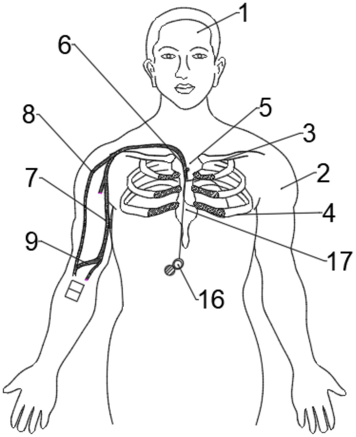 cn213211462u_一种经外周置入的中心静脉导管维护模型