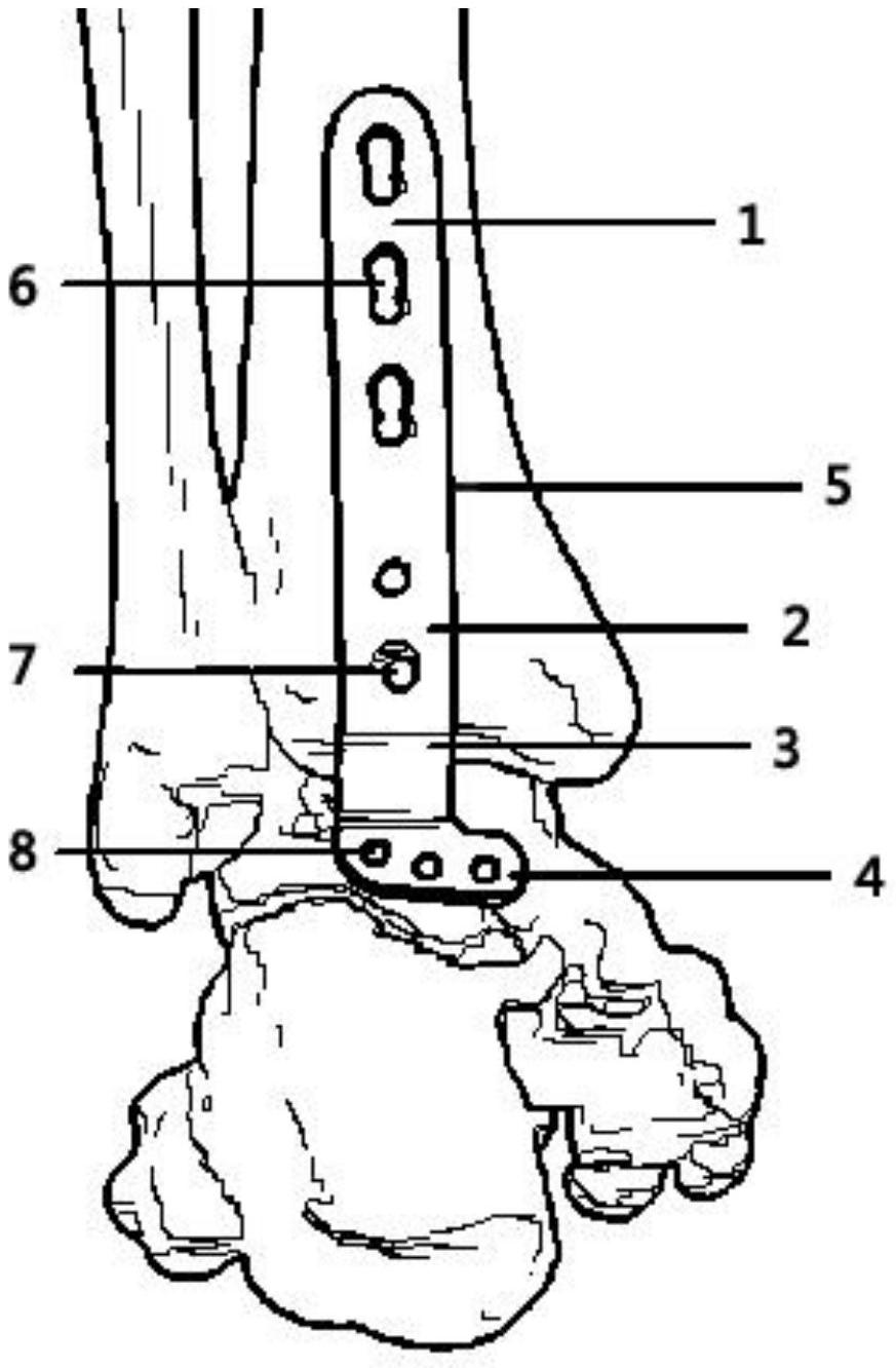 cn213372413u_一種踝關節後方融合鋼板有效
