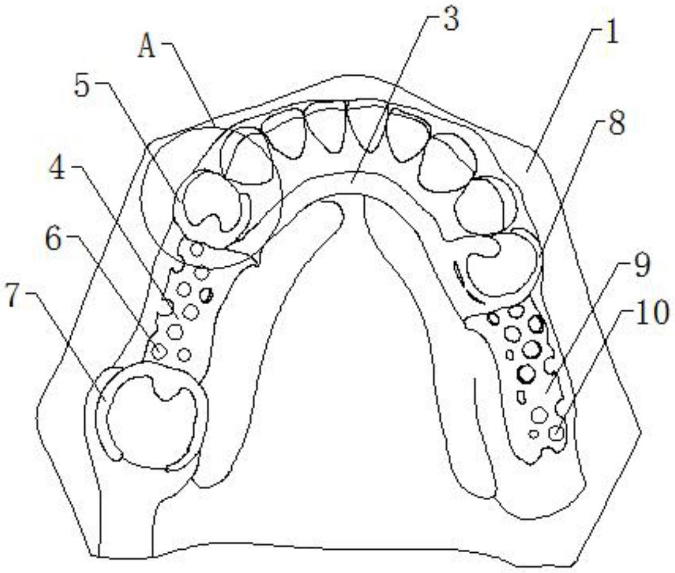 活动义齿支架设计图解图片
