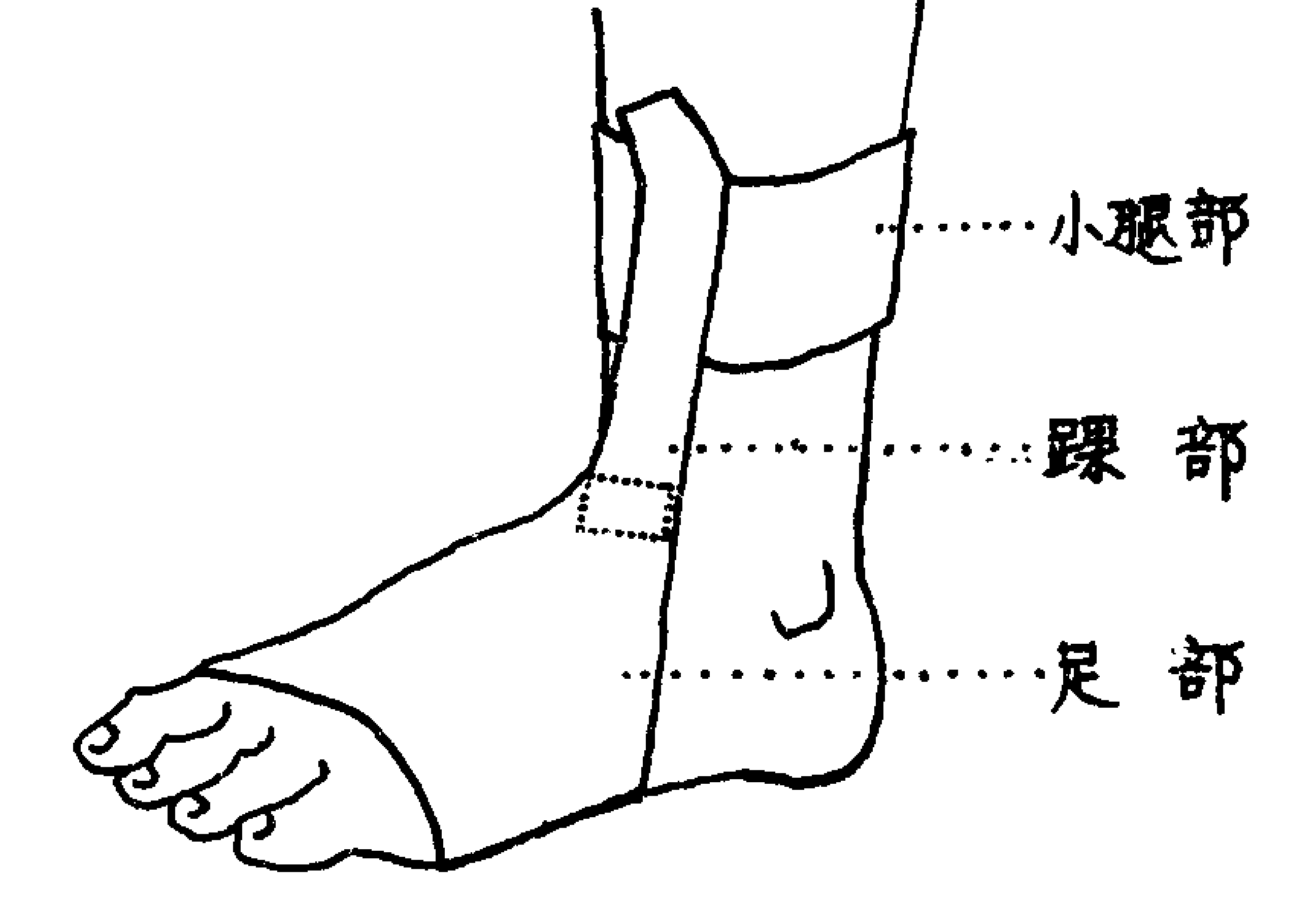 垂足矫正器