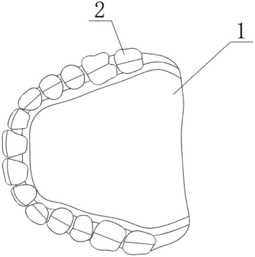 活动义齿设计单画法图片