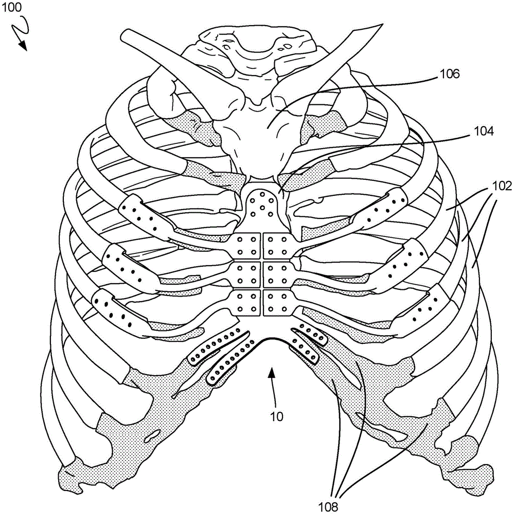 cn110191687a_可调肋骨和胸骨植入体